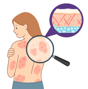 Na EB, a perda de colágeno fragiliza as fibras da pele, favorecendo a formação de bolhas e feridas.